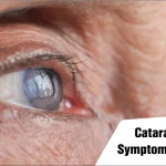 Cataracts