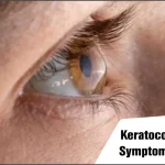Keratoconus: Causes, Symptoms, Treatment