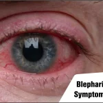 Blepharitis: Causes, Symptoms, Treatment