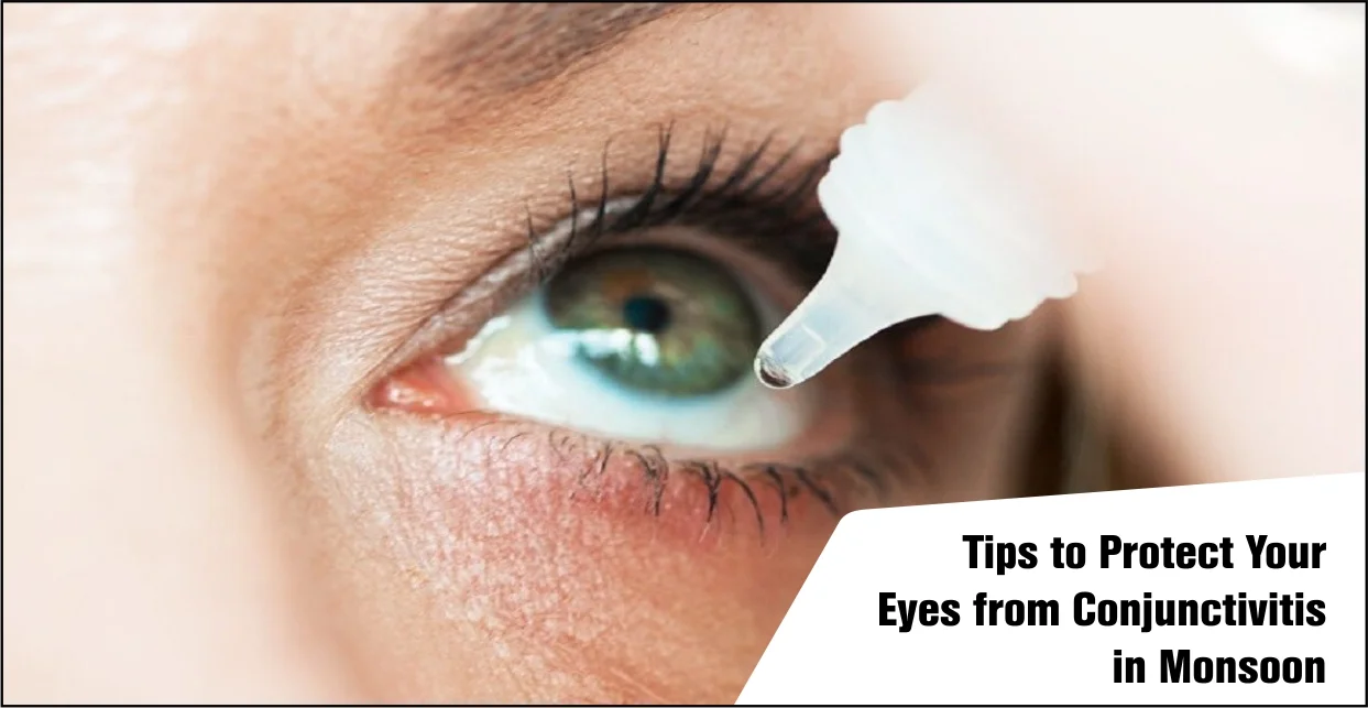 Conjunctivitis in Monsoon